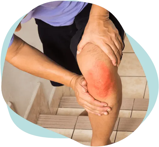 Person holding knee in pain with redness, representing acupuncture treatment for knee pain in East Setauket NY