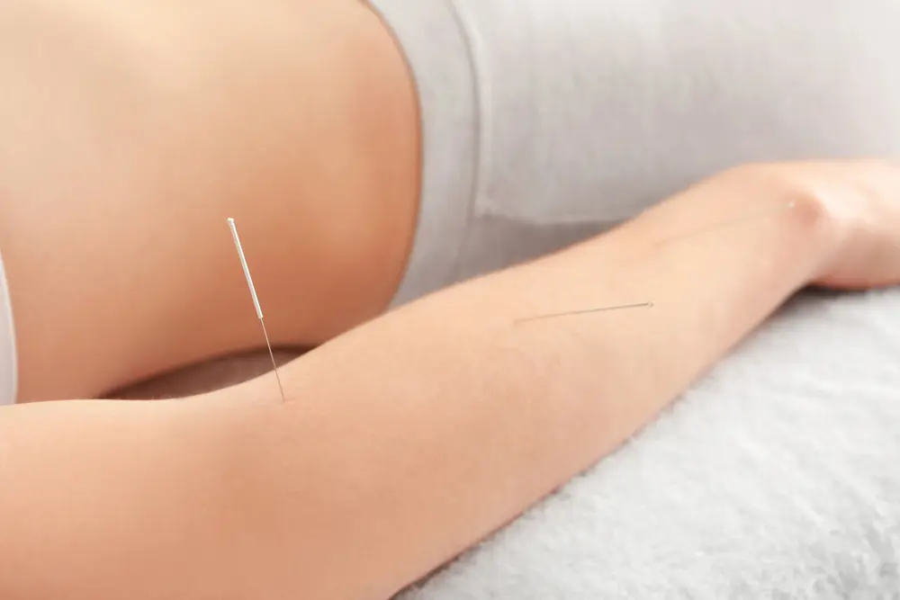 Why Acupuncture Is A Game-Changer For Tennis Elbow Relief